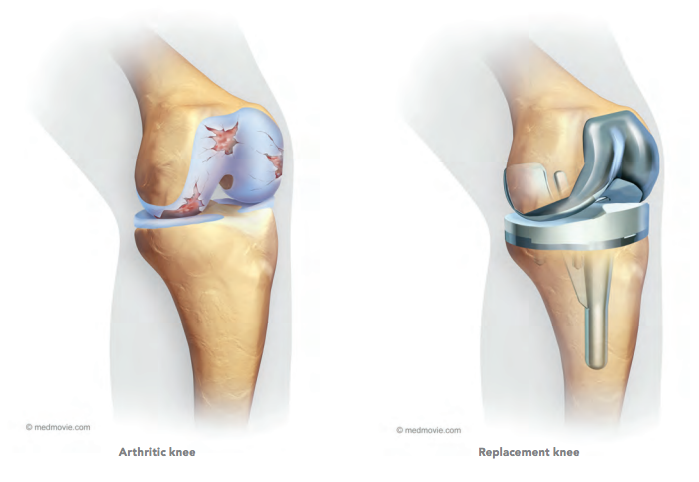 replacement-knee